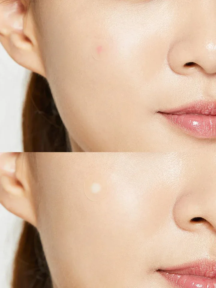 كوزركس باتش لصقات بامبل ماستر لمعالجة بثور حب الشباب - 24 رقعة  |  CosRx Acne Pimple Master Patch, 24 Patches