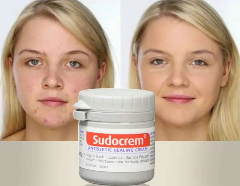 سودو كريم كريم معالج ومطهر 125 جم  |  Sudocrem Antiseptic Healing Cream 125g