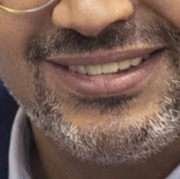 مكنة فيشار صحية