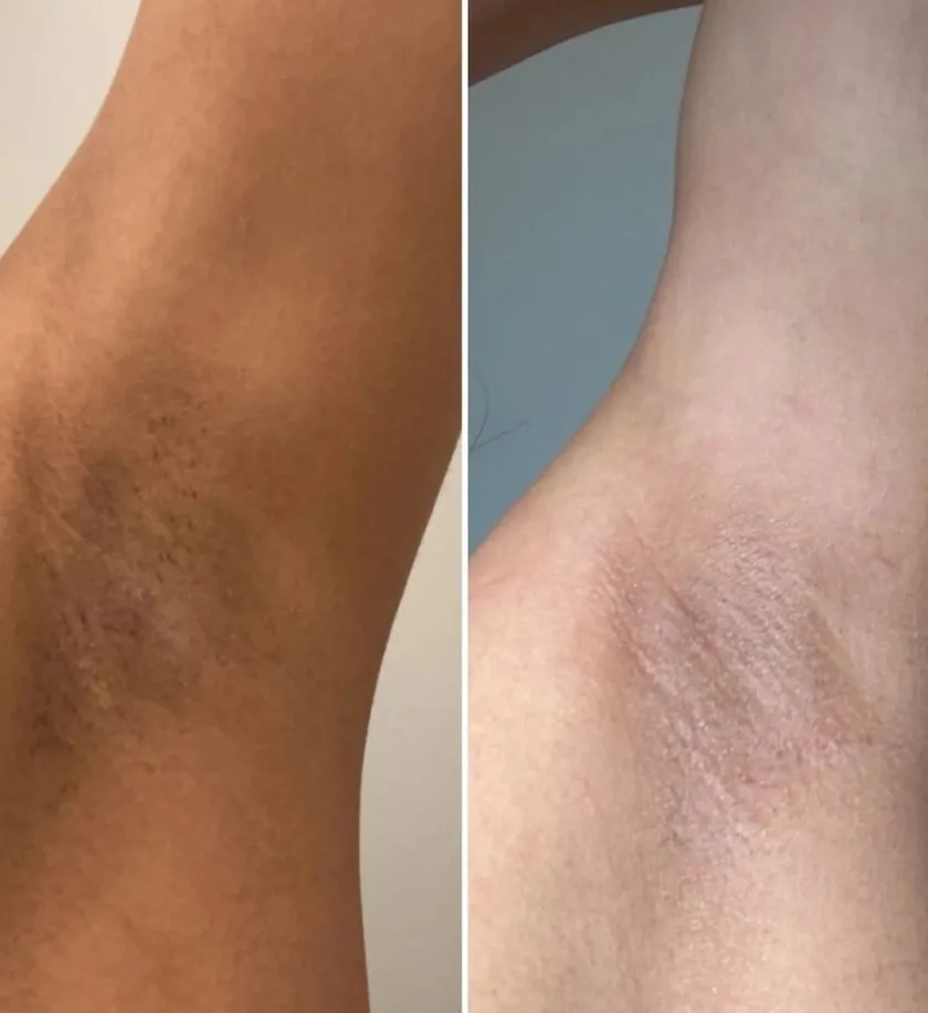 ستيك الجليكوليك أسيد لتفتيح وتقشير الجسم والأماكن الداكنة من جينزين | Genzen Glycolic Acid Body Stick