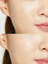كوزركس باتش لصقات بامبل ماستر لمعالجة بثور حب الشباب - 24 رقعة  |  CosRx Acne Pimple Master Patch, 24 Patches