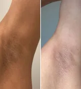ستيك الجليكوليك أسيد لتفتيح وتقشير الجسم والأماكن الداكنة من جينزين | Genzen Glycolic Acid Body Stick